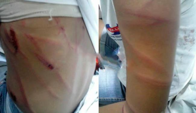 Criança ficou com vários hematomas após a agressão do pai (Foto: Jadiel Luiz | Blog do Sigi Vilares)