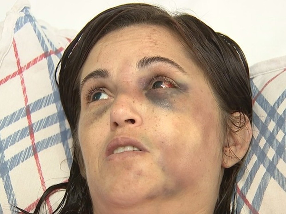 Sandra Almeida apanhou do marido e ficou com traumas no rosto (Foto: Reprodução/TV TEM) Sandra Almeida apanhou do marido e ficou com traumas no rosto (Foto: Reprodução/TV TEM)