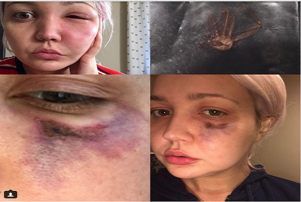 Mulher acorda com dor insuportável e um furo no rosto. A causa é assustadora