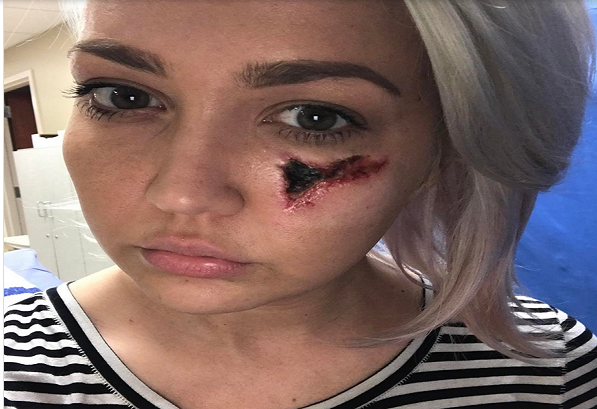 Por volta do nono dia, o tecido facial ao redor da picada começou a ficar preto, um sinal de necrose (quando o tecido morre)