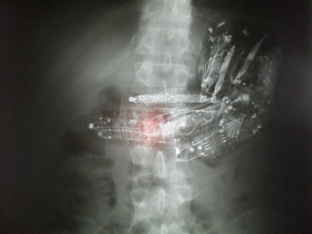 Detento passou por cirurgia para retirada de aparelhos (Foto: Divulgação/SAP) Detento passou por cirurgia para retirada de aparelhos (Foto: Divulgação/SAP)