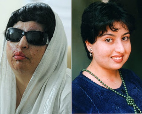 A iraniana Ameneh Bahrami, de 34 anos, ficou desfigurada depois que um colega de faculdade com quem ela se recusou a casar atirou ácido em seu rosto A iraniana Ameneh Bahrami, de 34 anos, ficou desfigurada depois que um colega de faculdade com quem ela se recusou a casar atirou ácido em seu rosto