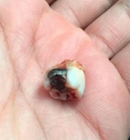 Bala ficou presa no dente do aposentado Bala ficou presa no dente do aposentado