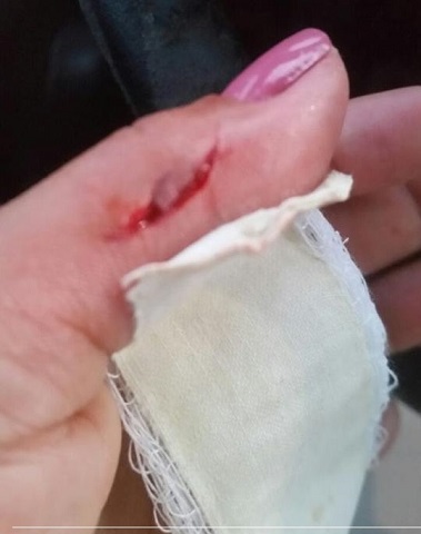 Tudo que Monica Franco queria era ser vacinada contra a Raiva, já que o animal que a atacou havia rasgado os tecidos de sua mão