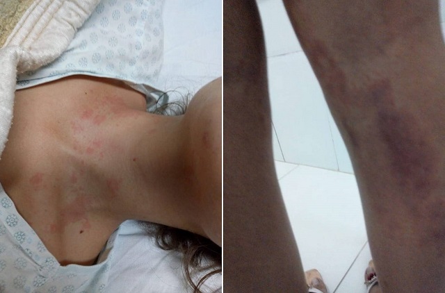 Moradora de Camaçari em tratamento contra Esporotricose depois de contrair o fungo (Foto: Montagem | Redação CFF) Moradora de Camaçari em tratamento contra Esporotricose depois de contrair o fungo (Foto: Montagem | Redação CFF)