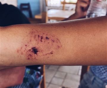 Apesar do susto, ela passa bem, ficando apenas com uma cicatriz ao redor do braço, que segundo os médicos que a atenderam, nunca mais sumirá de sua pele. Apesar do susto, ela passa bem, ficando apenas com uma cicatriz ao redor do braço, que segundo os médicos que a atenderam, nunca mais sumirá de sua pele.