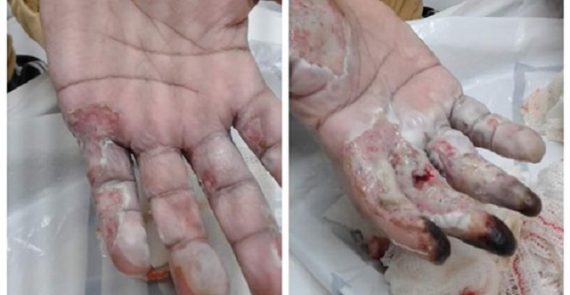 Homem sofre queimadura durante ataque epiléptico e corre risco de amputar os dedos da mão (Foto: Arquivo Pessoal)
