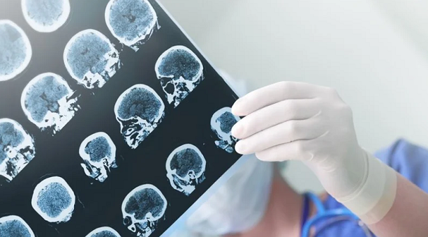 Por critério, morte encefálica, ou morte cerebral, é a perda completa e irreversível das funções do cérebro (Foto: Reprodução)