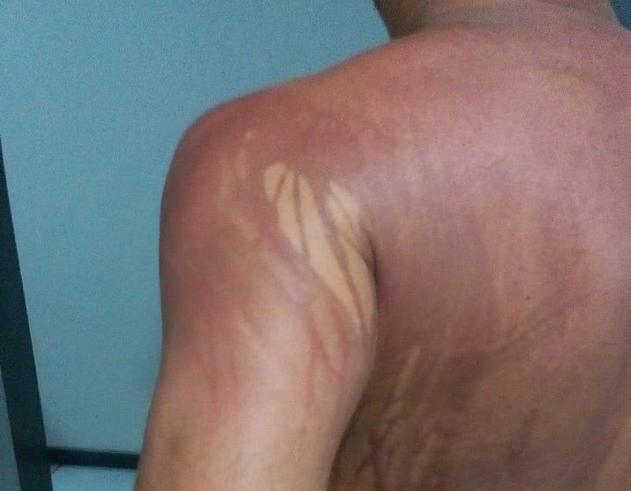 Turista Mineiro: 'Eu estava fazendo uma caminhada na areia. Aí na hora que eu fui tomar um banho de mar, fiquei uns 40 minutos dentro da água, o meu corpo começou a coçar e queimar e eu saí da água'