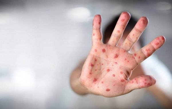 O Sarampo é uma doença viral aguda, potencialmente grave, transmissível e extremamente contagiosa (Foto: Reprodução)