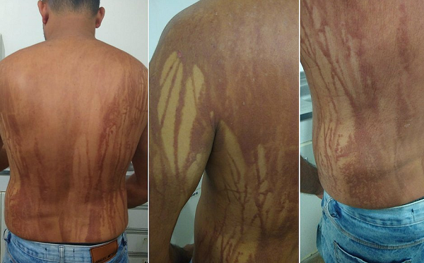 Turista mineiro Anderson Gabriel Palmela, 38 anos, apresentou suspeita de intoxicação por petróleo cru em Ilhéus após banho de mar (Foto: Acervo pessoal)