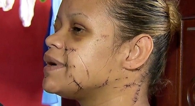Monique recebeu cerca de 100 pontos só no rosto depois das facadas (Foto: Reprodução | Record TV)