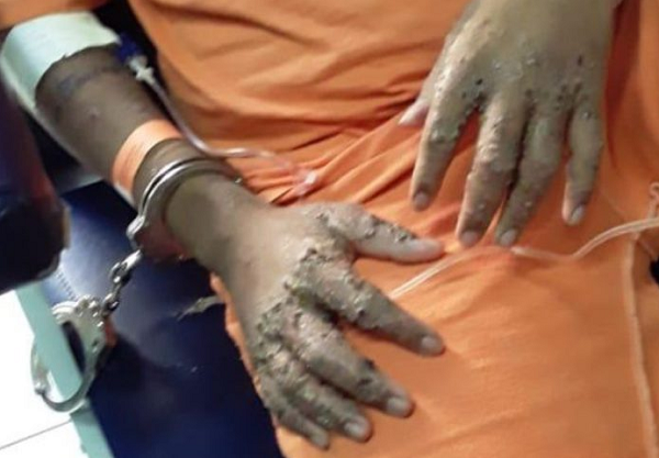 Mãos de um dos presos vítima da doença desconhecida (Foto: Blog do Peronnico)