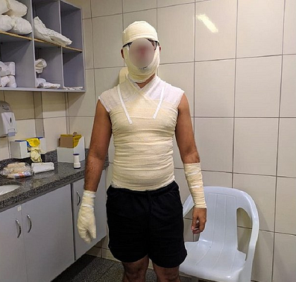 Cleiton Solano, de 24 anos, sofreu queimaduras de segundo grau (Foto: Acervo Pessoal)