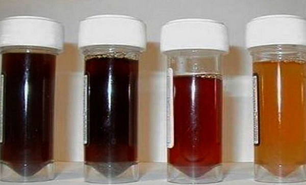 Doença pode evoluir rapidamente com insuficiência renal e, se não adequadamente tratada, levar ao óbito (Foto: Reprodução)