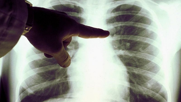 Sem medicação específica adicional, o linfoma de um paciente que contraiu o coronavírus desapareceu, segundo exame (Foto: Reprodução)