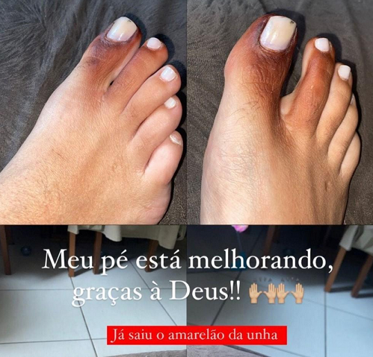 Três dias depois, a jovem postou uma foto dizendo que seu pé já estava melhor (Foto: Reprodução/Instagram)
