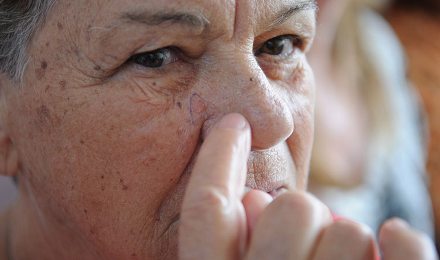 O tipo de câncer de pele que requer mais atenção é o melanoma (Foto: Fabio Rodrigues Pozzebom/Agência Brasil)