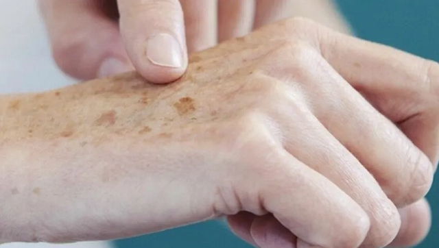 O tipo mais comum é o não melanoma (Foto: Agência Brasil)