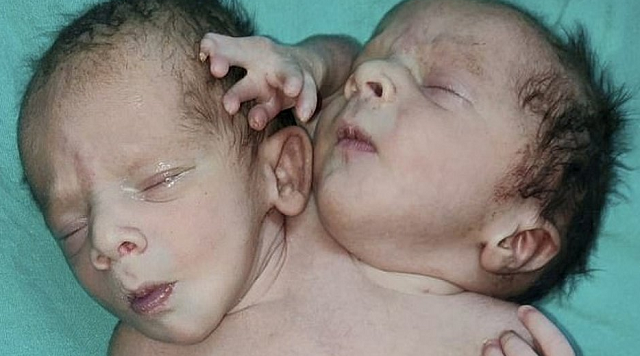 O nascimento das crianças parece ser um caso raro de gêmeos siameses, conhecido como parapagus dicefálico - onde dois bebês são unidos por um torso (Foto: Rareshot News/SWNS)