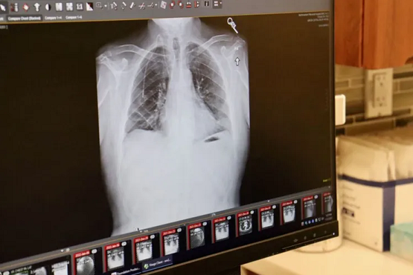 Apesar do estágio avançado, o câncer de Khoury não havia se espalhado para outras partes do corpo, o que permitiu que a cirurgia fosse realizada (Foto: NORTHWESTERN MEDICINE/AFP)