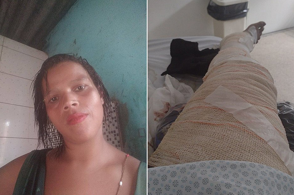 Angélica Rodrigues, de 26 anos, teve 85% do corpo queimado (Foto: Reprodução/Facebook)