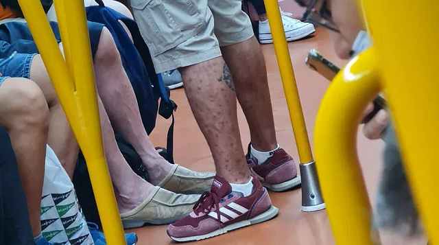 Passageiro está infectado com a varíola dos macacos (Foto: Reprodução)