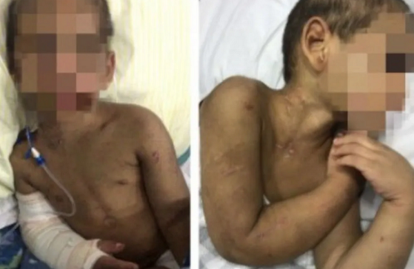 Criança teve oito costelas e um braço fraturados após a própria mãe agredi-lo brutalmente (Foto: Reprodução)