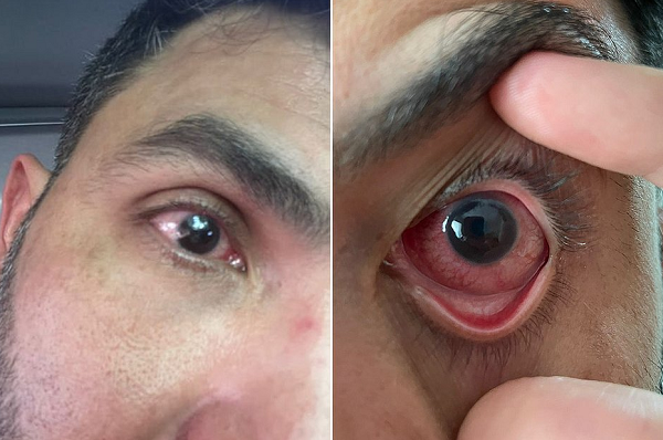 A espera de 60 dias pelo medicamento provocou a cegueira de um dos olhos, quadro que a literatura existente até hoje não sabe determinar se é reversível (Foto: Reprodução)