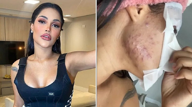 Ex-BBB e cantora Flay revelou diversos efeitos colaterais (Foto: Reprodução)
