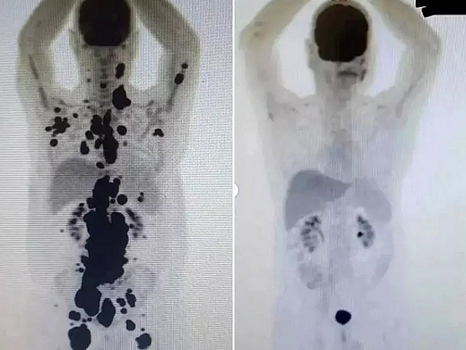 Chamado de terapia celular CAR-T Cell, o procedimento já é adotado nos Estados Unidos e em outros países para tratar linfomas e leucemias avançadas, como último recurso (Foto: Reprodução)