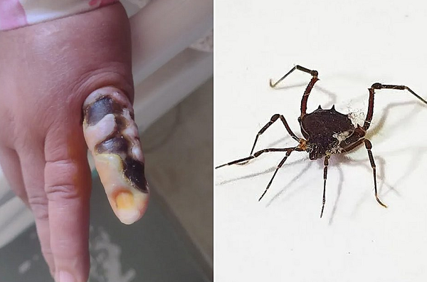 O dedo não vai precisar ser amputado, mas todo o tecido necrosa será removido (Foto: Reprodução)