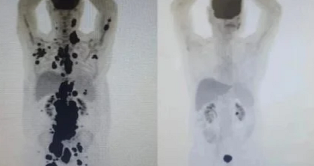 Comparação entre os exames de Paulo Peregrino, antes e depois do tratamento com Células CAR-T. Comparação entre os exames de Paulo Peregrino, antes e depois do tratamento com Células CAR-T (Foto: Reprodução/Instagram/paulocfperegrino)