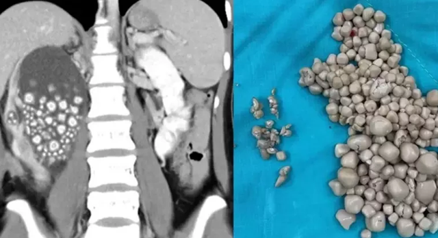 Caiyang listou a genética, a ingestão de água e a dieta como os fatores mais importantes para a formação de cálculos renais (Foto: Reprodução)