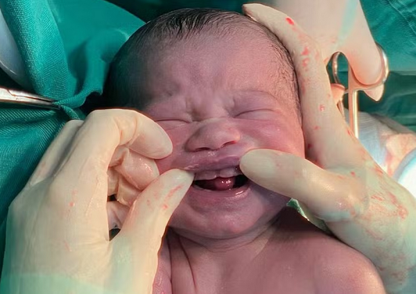 Bebê nasce com 6 'dentes' (Foto: Redes sociais)