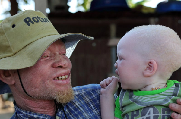 O dia 13 de junho é dedicado a incentivar a população a acabar com o preconceito contra os albinos e a apoiar a união das pessoas que têm essa condição genética, considerada rara (Foto: Reprodução)