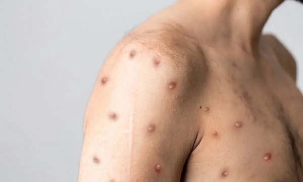 Doença mpox, antes chamada de varíola dos macacos (Foto: Reprodução)