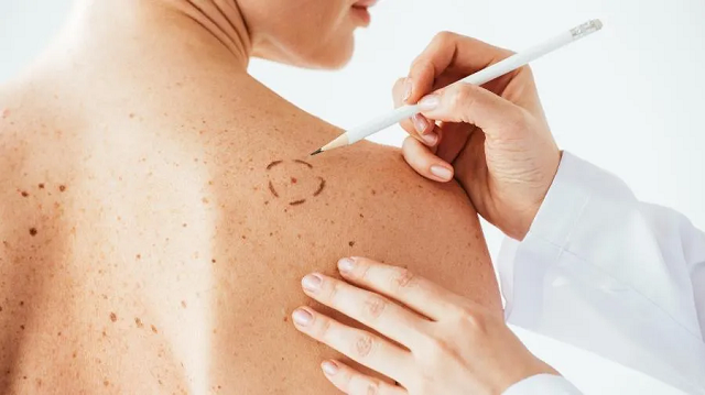 É importante observar alterações de lesões cutâneas ou 'pintas' (Foto: iStock)