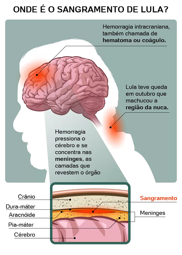 Revisão: Mauricio Panicio, neurocirurgião (Imagem: Arte UOL)