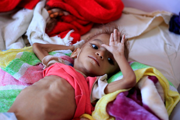Apesar dos sucessos de longo prazo na luta contra a fome, a situação global da fome continua séria para o estudo Global Hunger Index (WHI) 2018 (Foto: Reprodução) Apesar dos sucessos de longo prazo na luta contra a fome, a situação global da fome continua séria para o estudo Global Hunger Index (WHI) 2018 (Foto: Reprodução)