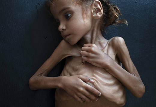 Amal Hussain, uma garota de 7 anos cuja imagem deitada em uma cama de hospital no norte do Iêmen se tornou o símbolo da fome no país (Foto: Tyler Hicks | The New York Times) Amal Hussain, uma garota de 7 anos cuja imagem deitada em uma cama de hospital no norte do Iêmen se tornou o símbolo da fome no país (Foto: Tyler Hicks | The New York Times)