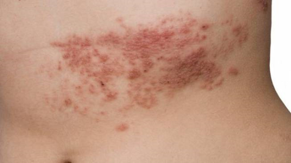 Entre os principais sintomas estão exantemas – quando há o aparecimento de erupções cutâneas vermelhas em uma região específica ou por todo o corpo (Foto: Reprodução) Entre os principais sintomas estão exantemas – quando há o aparecimento de erupções cutâneas vermelhas em uma região específica ou por todo o corpo (Foto: Reprodução)
