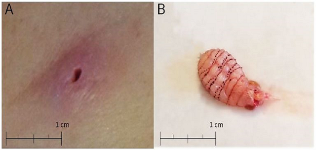 As larvas infectam um hospedeiro através de ovos transferidos por um mosquito ou picadas de moscas (Foto: Reprodução)