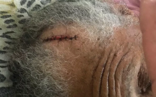 Idosa de 79 anos precisou levar pontos na cabeça após agressão com machado (Foto: Divulgação | Notícias de Santaluz)