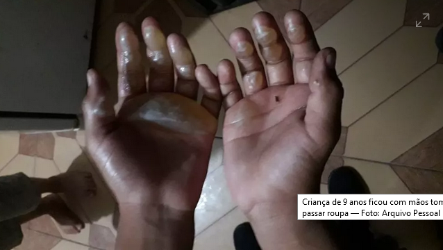 Criança de 9 anos ficou com mãos tomadas por bolhas da queimadura com ferro de passar roupa — Foto: Arquivo Pessoal (Foto: Arquivo Pessoal) Criança de 9 anos ficou com mãos tomadas por bolhas da queimadura com ferro de passar roupa — Foto: Arquivo Pessoal (Foto: Arquivo Pessoal)
