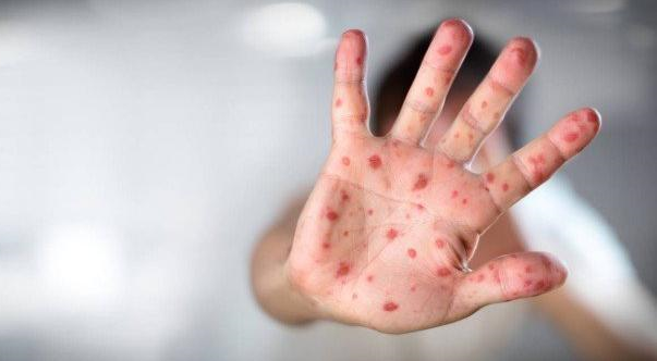  A secretaria determinou que os municípios notifiquem imediatamente qualquer caso suspeito da doença em pacientes que apresentarem os sintomas (Foto: Reprodução)