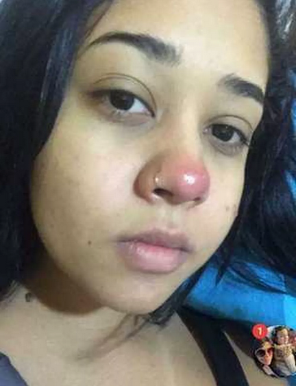 Um dos primeiros sintomas da infecção sofrida por Layane Dias foi uma 'bola vermelha' no nariz (Foto: Arquivo pessoal | via BBC) 