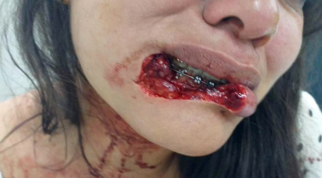 Vítima que perdeu de 70% a 80% do lábio inferior passou por microcirurgia reparadora (Foto: Reprodução) Vítima que perdeu de 70% a 80% do lábio inferior passou por microcirurgia reparadora (Foto: Reprodução)