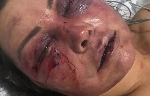 Elaine levou quase 40 pontos dentro da boca. Também sofreu fratura no nariz e nos ossos da órbita (região próxima aos olhos) (Foto: Reprodução) Elaine levou quase 40 pontos dentro da boca. Também sofreu fratura no nariz e nos ossos da órbita (região próxima aos olhos) (Foto: Reprodução)