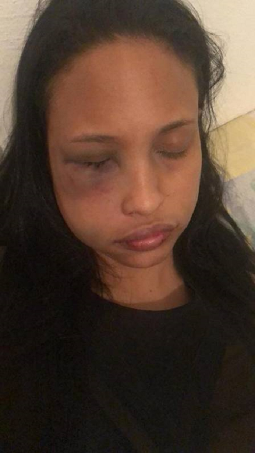Bianca sofreu fraturas nos ossos da face (Foto: Reprodução redes sociais)